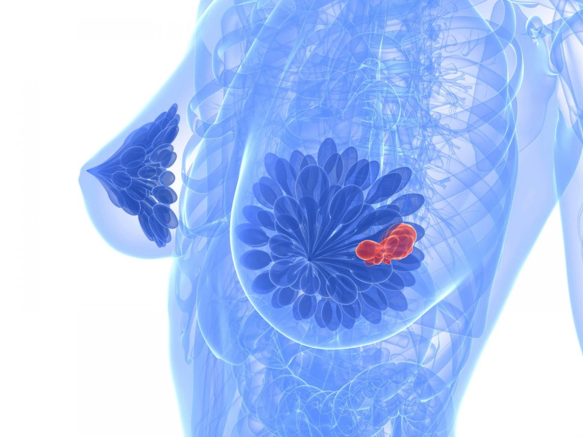 breast-cancer-illustration-1200x900.jpg